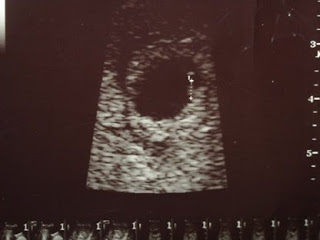 Pregnancy Update – 8 Weeks